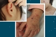 5岁女孩双脚皮疹，以为是蚊子叮咬！结果住院48天……