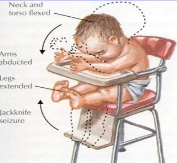 角弓反张图片 婴儿图片
