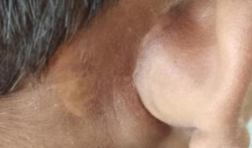 11岁孩子全身红疹4年未愈，耳后长包，病因扑朔迷离……