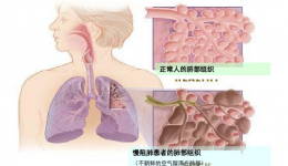 天氣轉(zhuǎn)涼，需警惕“呼吸殺手”，特別是這些人群！