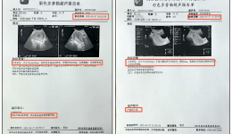 產后胎物殘留怎么辦？中醫(yī)除了生化湯，還有這些……