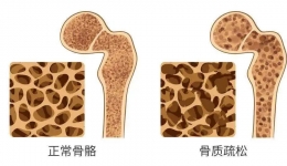 不讓身體變成一座“危房”，絕經(jīng)期后的你特別要關注這個指標......