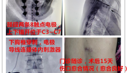 阿姨車禍后四肢疼痛2年，這個鎮(zhèn)痛療法助力擺脫疼痛！這些情況最適合……