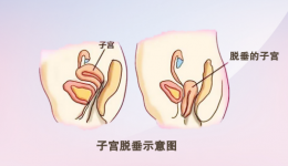 阿姨勞累就感覺有東西從下體掉出，竟是因為·····女性高發(fā)的難言之隱，千萬別忽視！