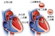 阿伯咳嗽、气促以为是感冒，结果“心门”坏了，怎么补？
