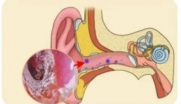 感覺(jué)耳朵潮濕發(fā)癢？當(dāng)心是這種病“作祟”！