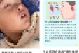 孩子腺样体肥大，到底要不要切？