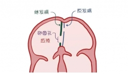 “小心眼”真的是心臟上有個(gè)小洞洞！四分之一人都有，總頭疼……