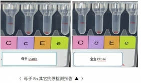 有一種新生兒溶血病，寶寶皮膚不黃但也很危險(xiǎn)，你知道是哪一種嗎？