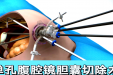 把疤痕“藏”进肚脐！女子胆囊术后创口几乎隐形！