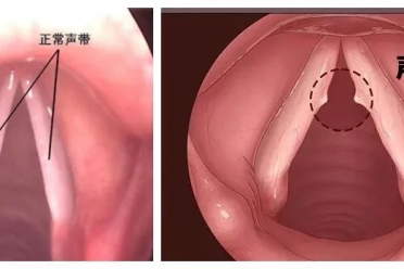 暑假孩子爱吵爱叫变“公鸭嗓”？当心是声带在求救！