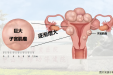 子宫巨大肌瘤13斤重！切还是不切？