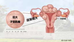 子宫巨大肌瘤13斤重！切还是不切？