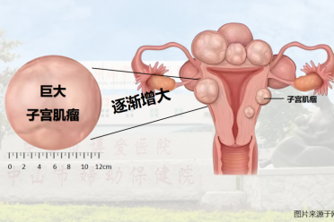子宫巨大肌瘤13斤重！切还是不切？