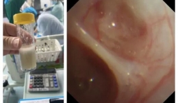 6岁女孩“感冒”后，喘不上气，命悬一线……