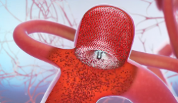 脑子里“炸”了？64岁阿姨突发爆炸性头痛……