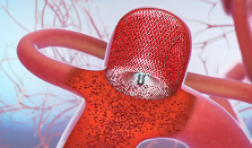 脑子里“炸”了？64岁阿姨突发爆炸性头痛……