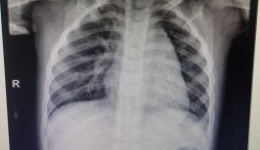 险！2岁孩子误吞硬币、电池？别用土方法！