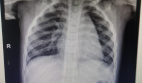 险！2岁孩子误吞硬币、电池？别用土方法！