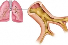 【警惕】9岁男孩反复咳嗽、咳脓痰！确诊经历让人深思......