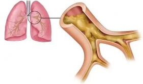 【警惕】9岁男孩反复咳嗽、咳脓痰！确诊经历让人深思......