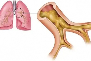 【警惕】9岁男孩反复咳嗽、咳脓痰！确诊经历让人深思......