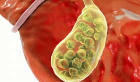 查出了胆囊结石，切还是保？