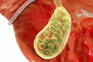 查出了胆囊结石，切还是保？