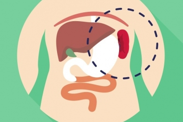 从“钥匙孔”里切除巨大脾脏！20岁重型地贫女子迎来新生