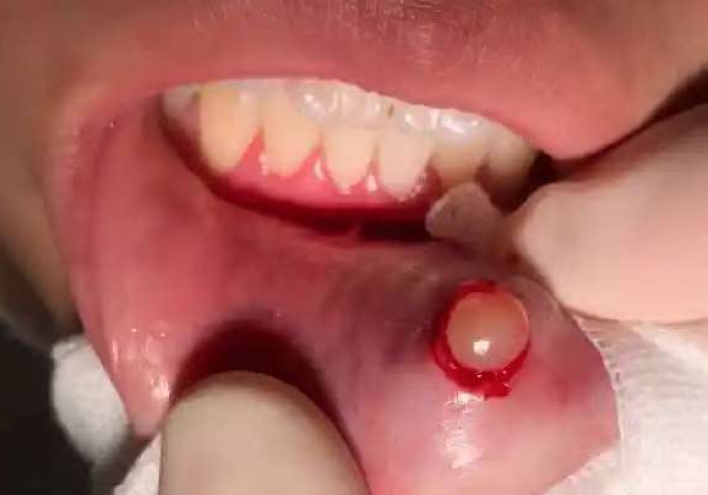 嘴唇上的“透明水泡”破了又长？别以为是上火！