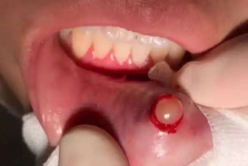 嘴唇上的“透明水泡”破了又长？别以为是上火！