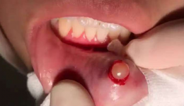 嘴唇上的“透明水泡”破了又长？别以为是上火！