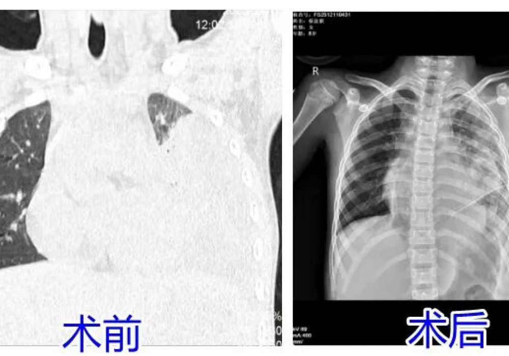发热咳嗽8天，孩子肺差点“废了”！这些信号别忽视
