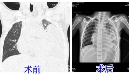 发热咳嗽8天，孩子肺差点“废了”！这些信号别忽视