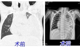 发热咳嗽8天，孩子肺差点“废了”！这些信号别忽视