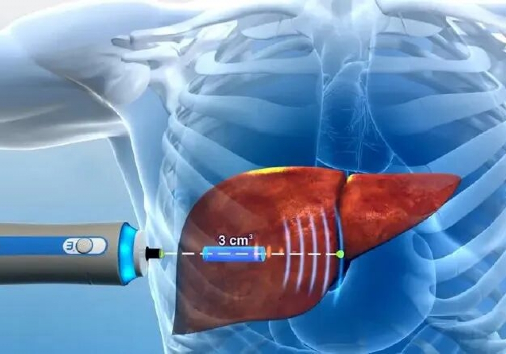 从肝硬化到癌变仅一步之遥！这8类人立刻自查→