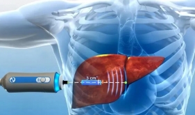 从肝硬化到癌变仅一步之遥！这8类人立刻自查→