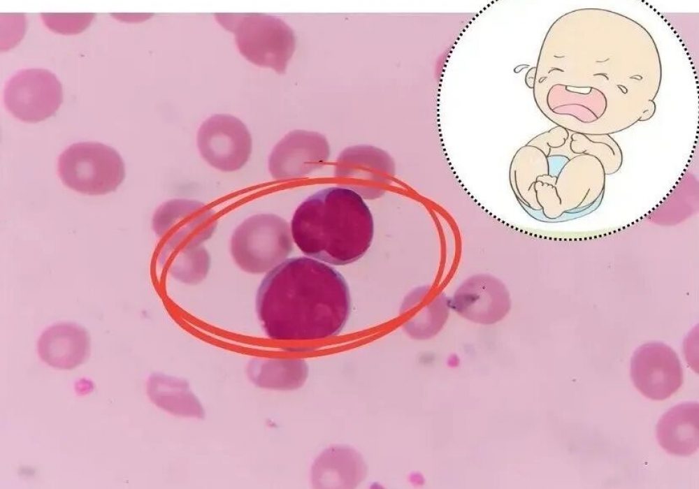 比熊猫血更罕见！新生儿出生24小时，血红蛋白只剩1/3……