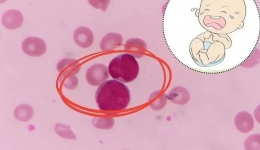 比熊猫血更罕见！新生儿出生24小时，血红蛋白只剩1/3……