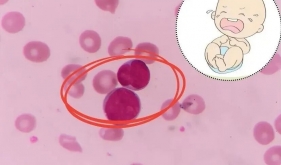 比熊猫血更罕见！新生儿出生24小时，血红蛋白只剩1/3……