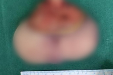 孕期产检发现腹中胎儿有条“尾巴”，夫妻俩慌了，结果......