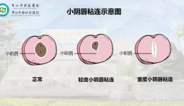 3岁女孩得了妇科病 ？女宝家长一定要懂的私处“小秘密”