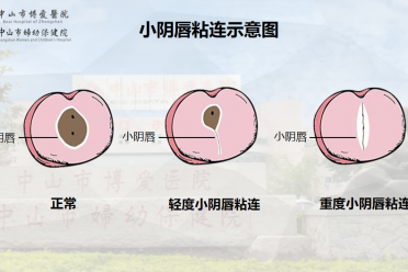 3岁女孩得了妇科病 ？女宝家长一定要懂的私处“小秘密”