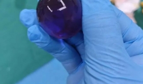 1岁8个月宝宝呕吐不止，肚里竟取出3cm“水宝宝”！