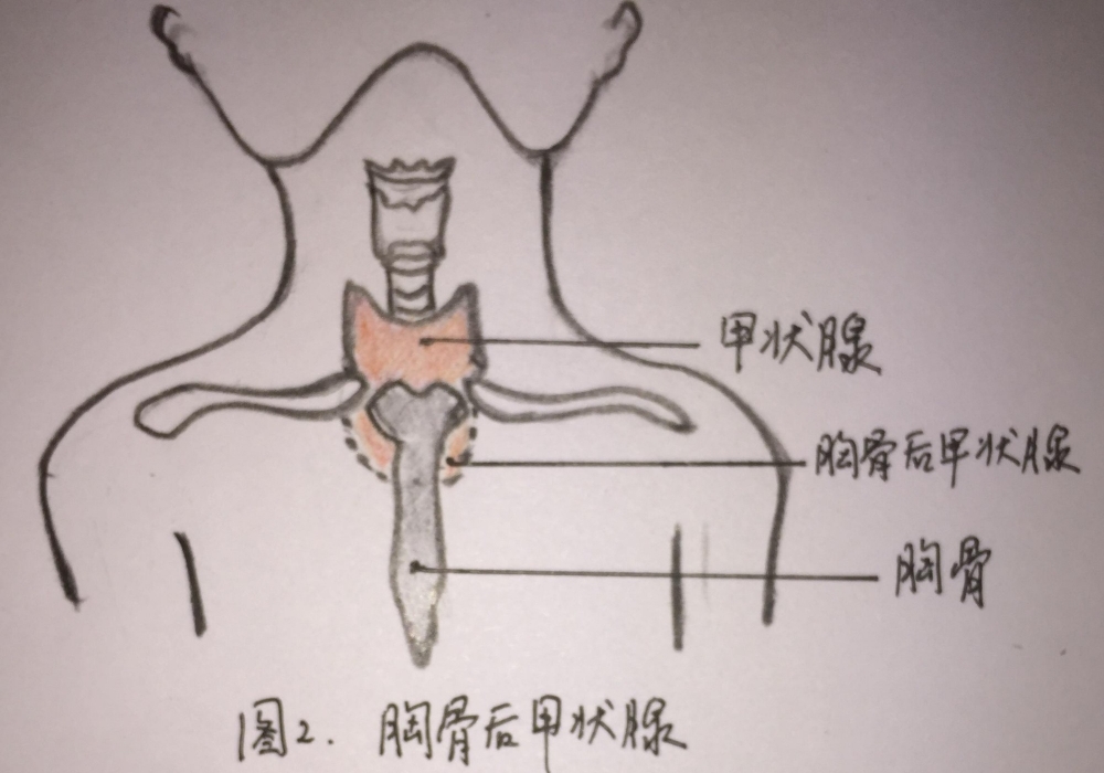 不开胸，除重患：胸骨后甲状腺肿的微创突围之路