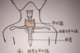 不开胸，除重患：胸骨后甲状腺肿的微创突围之路