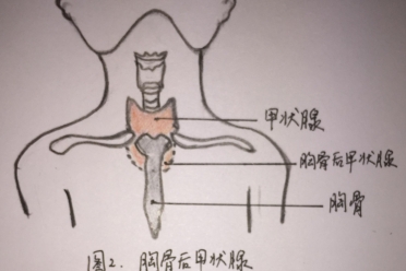 不开胸，除重患：胸骨后甲状腺肿的微创突围之路
