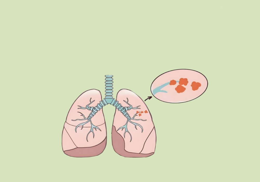 体检查出“肺结节”，离癌症还有多远？90%的人都在自己吓自己