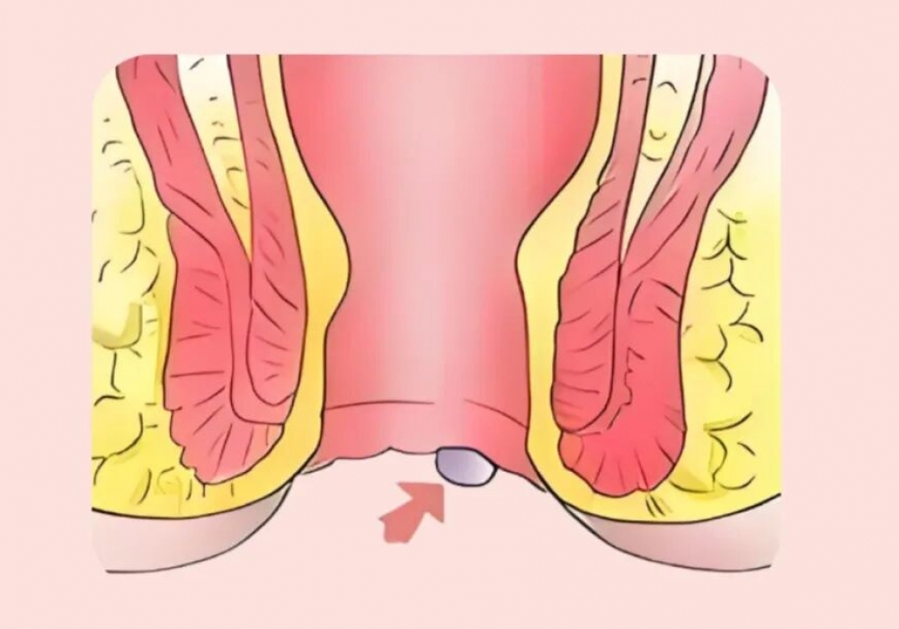 痔疮术后还长肉疙瘩？手术白做了？