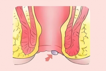 痔疮术后还长肉疙瘩？手术白做了？